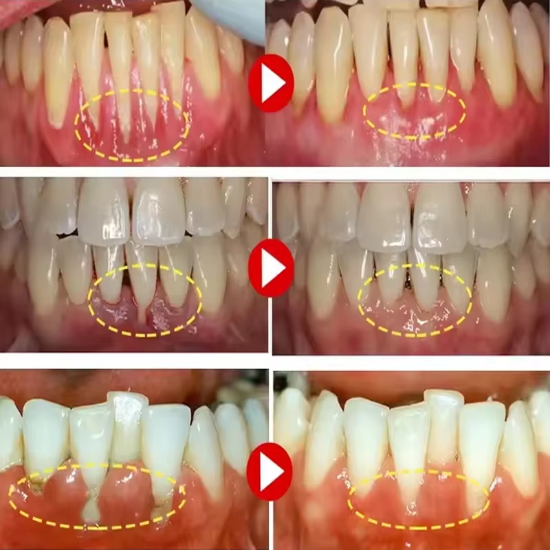 歯のホワイトニングジェル 歯肉修復ケア 歯肉の損傷を改善 炎 - Teeth Whitening Gels のレビューと価格