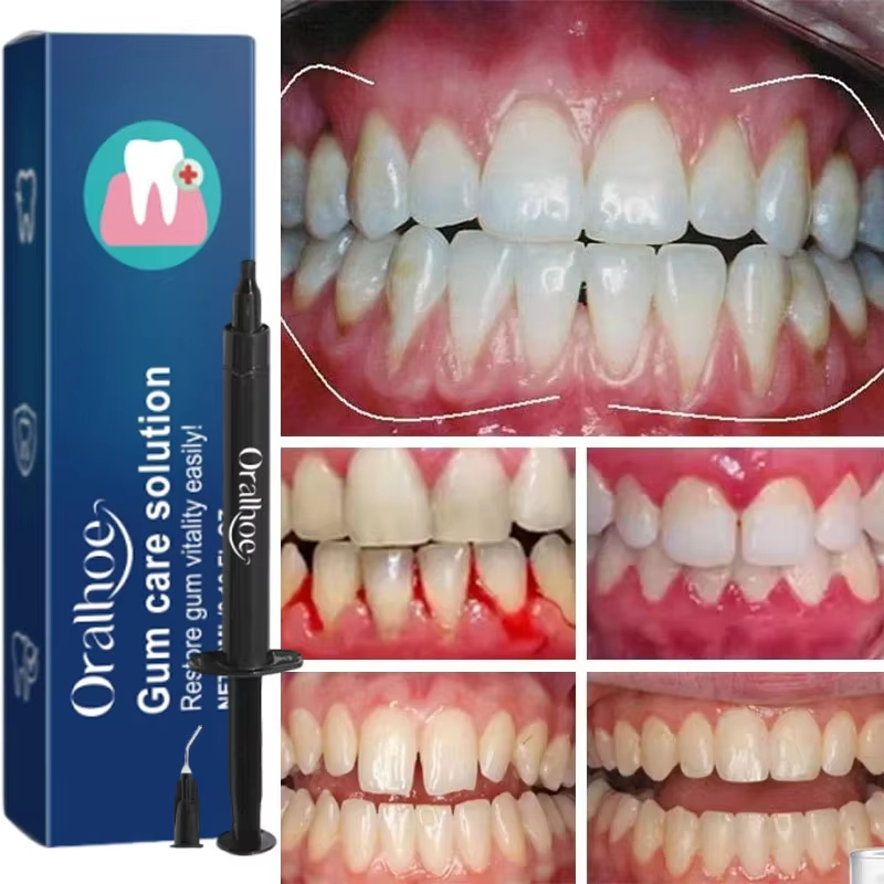 歯のホワイトニングジェル 歯肉修復ケア 歯肉の損傷を改善 炎 - Teeth Whitening Gels のレビューと価格
