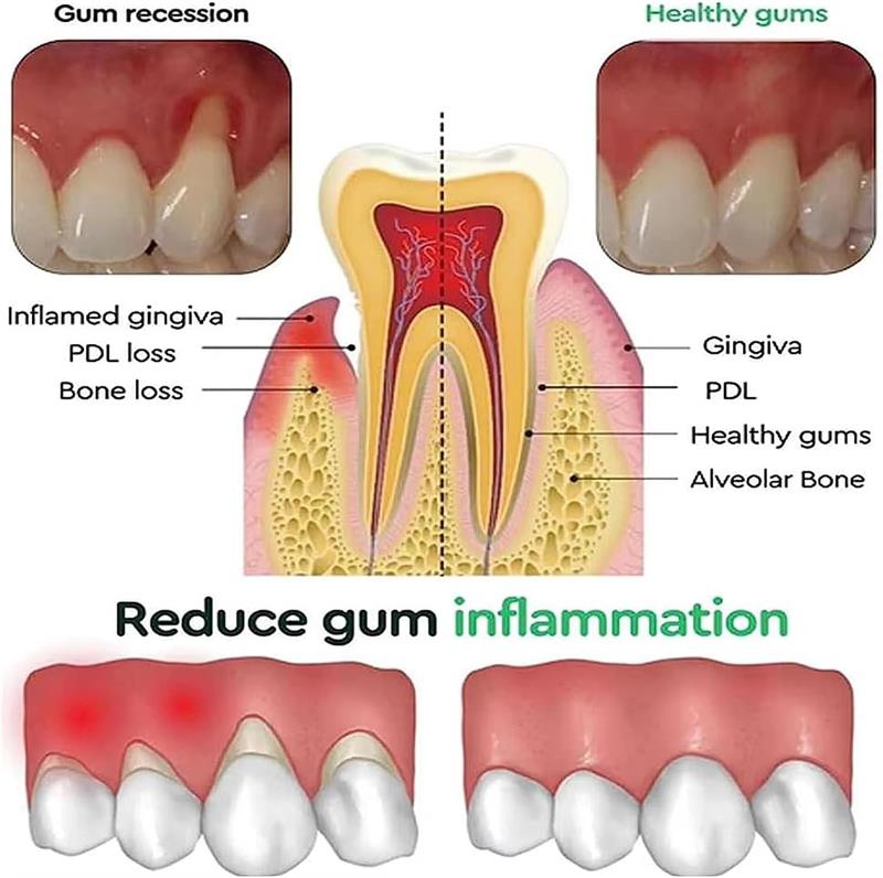 歯のホワイトニングジェル 歯肉修復ケア 歯肉の損傷を改善 炎 - Teeth Whitening Gels のレビューと価格