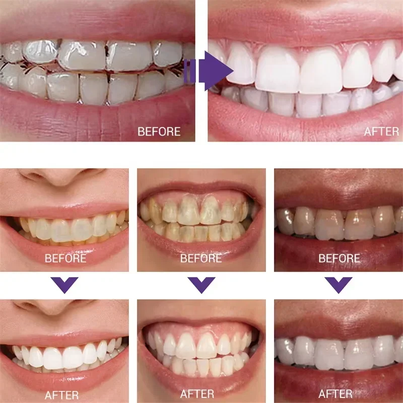歯のクリーニング ホワイトニング歯磨き粉 ホワイトニングジェ - Teeth Whitening In Korea のレビューと価格